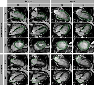 Impact of myocardial deformation on risk prediction in patients following acute myocardial infarction